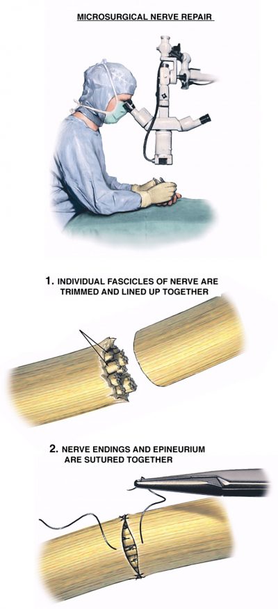 Nerve Injury Treatment