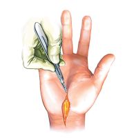 Carpal Tunnel Syndrome - The Complete Guide
