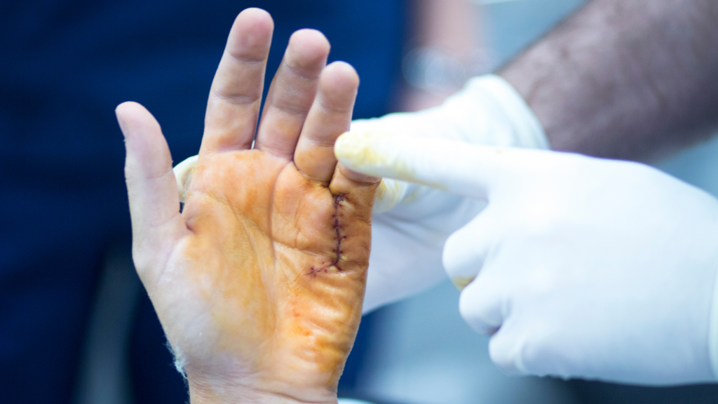 What is the Success Rate of Carpal Tunnel Surgery? - The Nerve Surgery ...